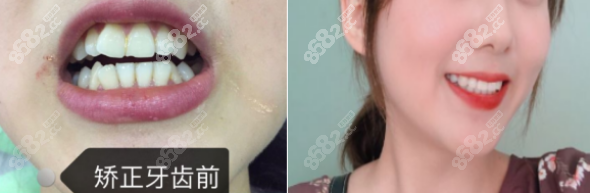口腔牙齿矫正案例