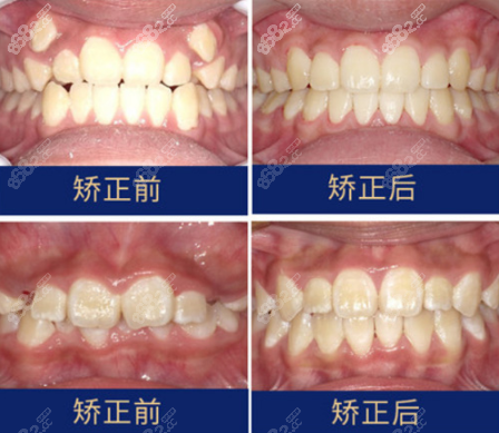隐适美隐形矫正效果图