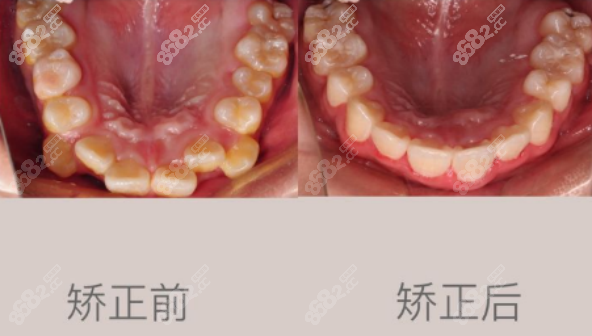 医院口腔科正畸案例