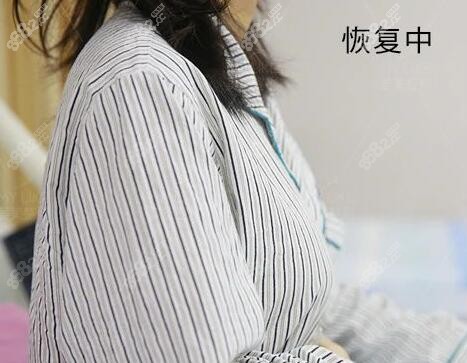 傲诺拉假体隆胸术后恢复中