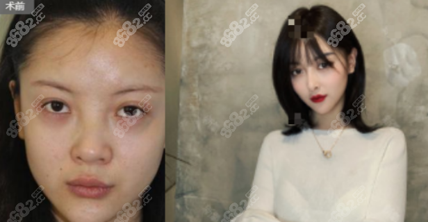 <!--<i data=20240705-sp></i>-->三里屯假體隆鼻案例二