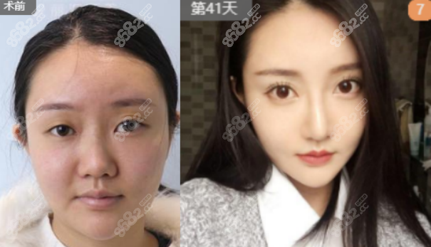 <!--<i data=20240705-sp></i>-->三里屯做假體隆鼻案例一