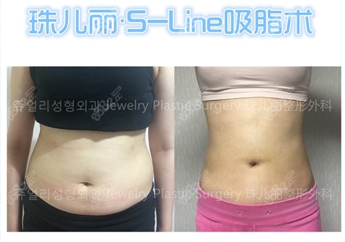 韩国珠儿丽腰腹吸脂案例