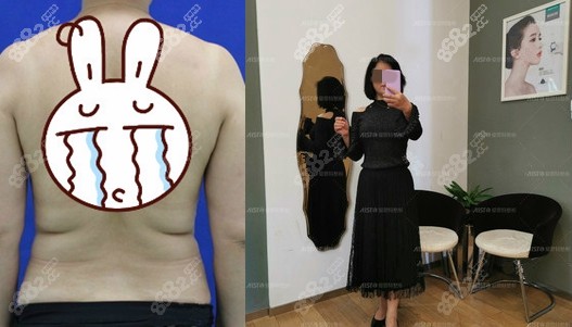 广州中山爱思特吸脂案例