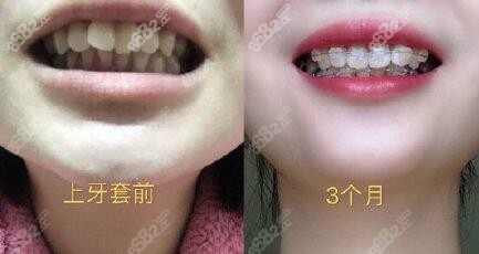 胶州玉齿牙科矫正牙齿案例效果