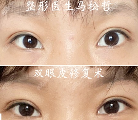 马松哲医生的双眼皮修复案例