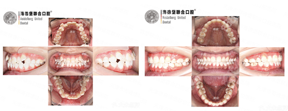 天津海德堡口腔医院隐适美隐形矫正案例