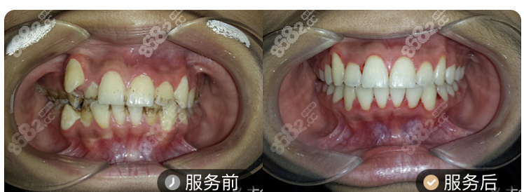 宁波牙博士口腔医院正畸案例