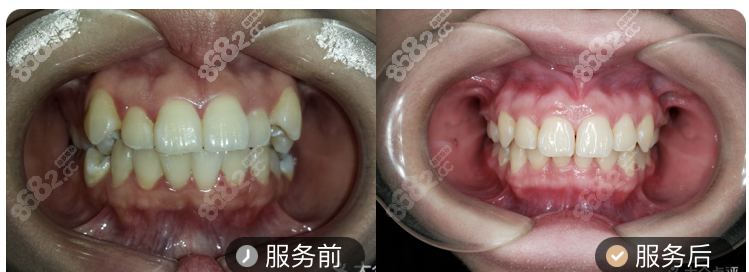 宁波牙博士口腔医院时代天使矫正案例