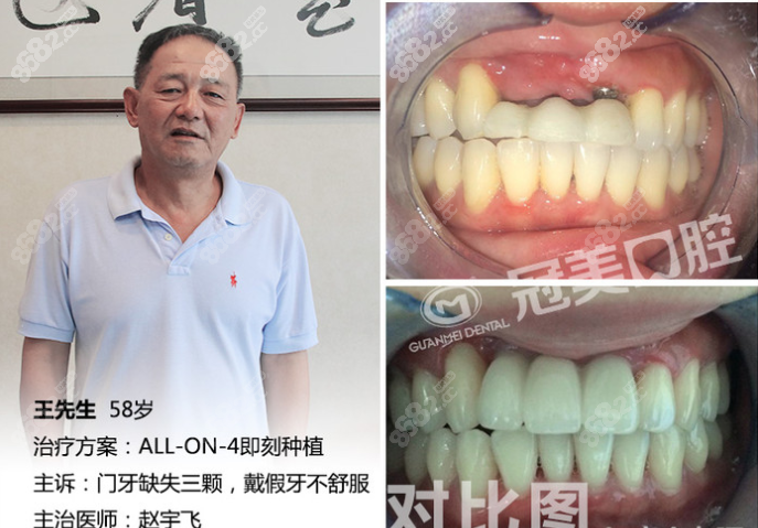 北京冠美口腔医院种植牙案例