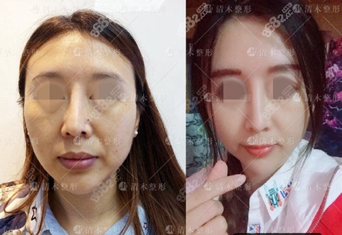 北京清木医疗美容马梅生自体脂肪填充前后对比照片