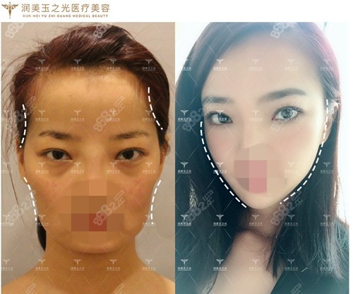 北京润美玉之光王明利医生自体脂肪填充前后对比照片