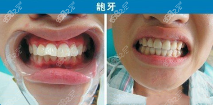 龅牙隐适美矫正效果图