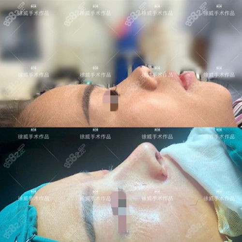 贵阳十大隆鼻鼻修复医生——徐威隆鼻前后对比照片