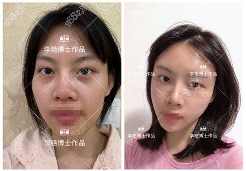 北京煤医医疗美容医院李艳自体脂肪填充前后对比照片