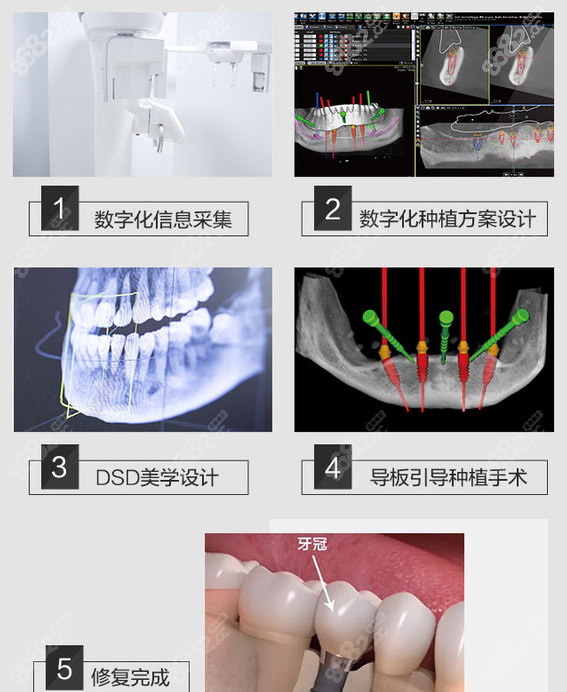 天津中诺口腔医院立得用种植牙过程