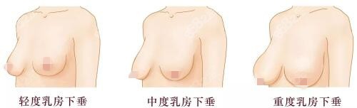 胸部下垂松弛的三种不同程度