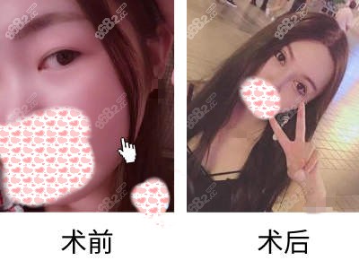 杭州美莱双眼皮手术<span style=