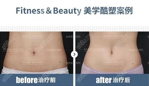北京联合丽格酷塑冷冻减脂瘦腰腹真人对比案例图