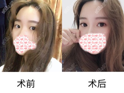 杭州美莱眼部整形<span style=