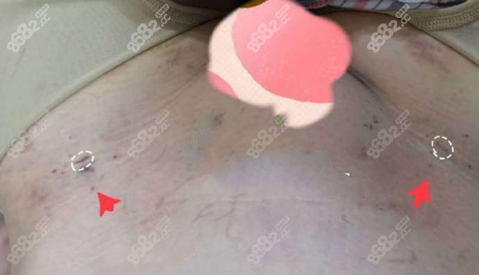 大腿吸脂一年后留下明显的针眼疤痕