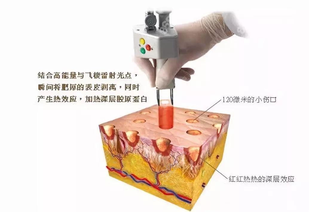 点阵激光去除抽脂后留下的针眼疤痕很有用