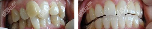 银川矫牙专业的艾齿口腔牙齿矫正案例