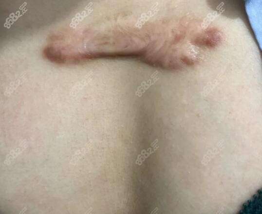 胸前8年的疤痕疙瘩怎么治疗