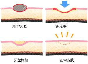 点阵激光治疗凹陷疤痕原理