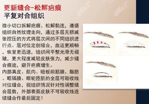 北京尚益嘉容常冬青双眼皮修复手术优势