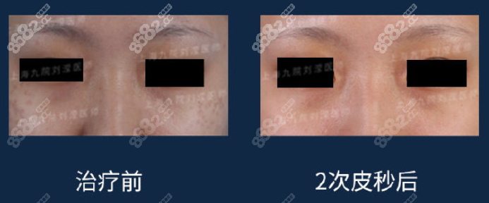 皮秒激光治疗褐青色斑效果图