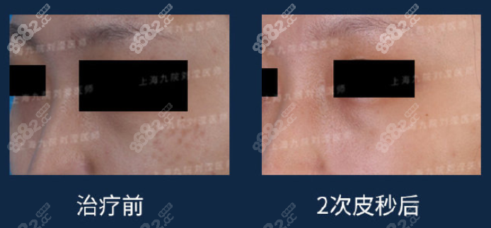 2次皮秒激光褐青色斑对比图