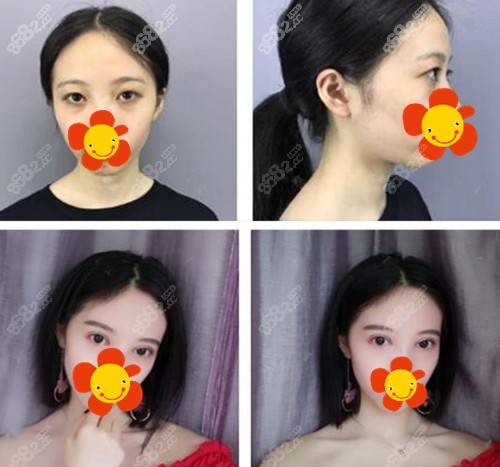 北京尚益嘉容常冬青双眼皮修复前后对比图