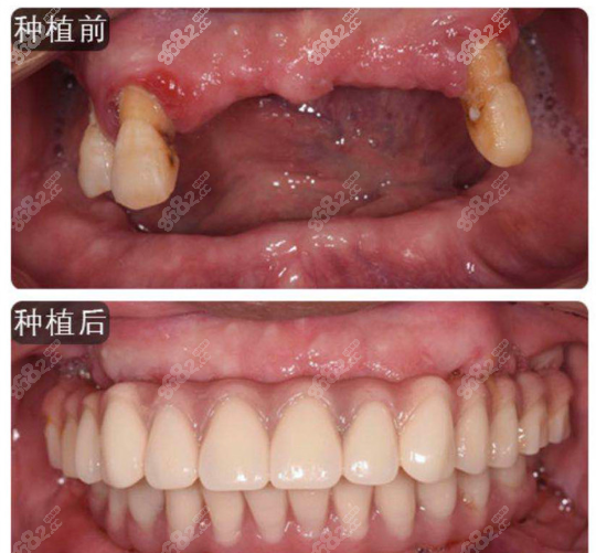 义乌傅氏口腔全口种植牙案例