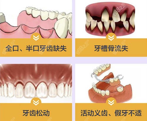 牙齿缺失种植牙模型