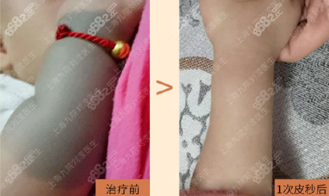 伊藤痣治疗效果图