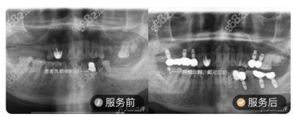 海南微笑口腔杨日桂医生种植牙案例