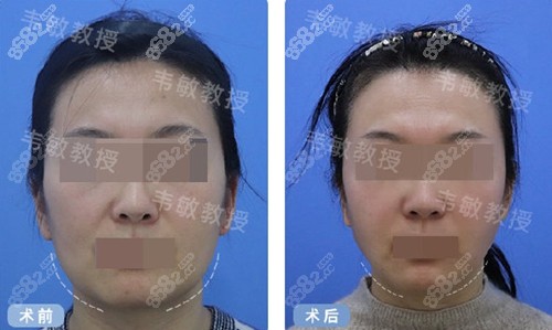 上海九院韦敏下颌角手术前后对比