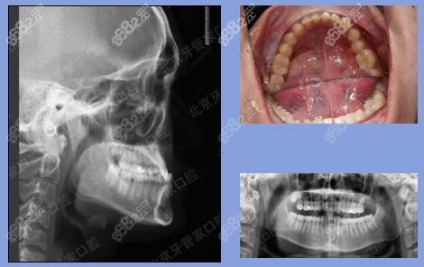 牙齿矫正术前拍片照