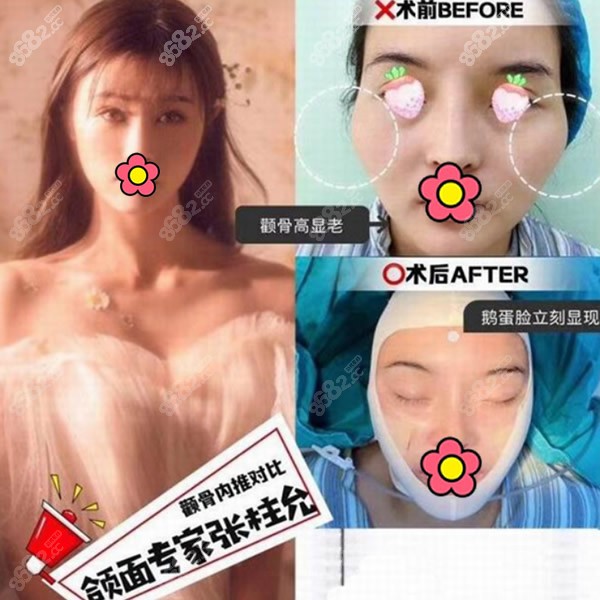 張柱允醫(yī)生磨骨效果怎么樣