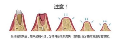 缺牙会导致牙槽骨骨量不足