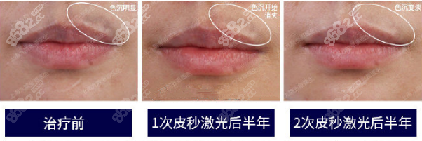 去黑色素案例图