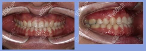 在北京牙管家口腔矫正牙齿完成效果照
