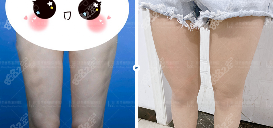 重庆郑荃丽格大腿脂肪修复案例图2