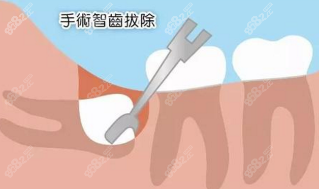 阻生齿拔出