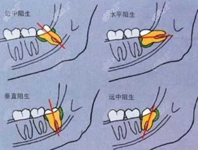 智齿生长方式