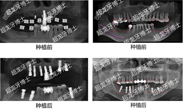 超龙牙博士种植牙案例