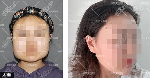 北京圣嘉新医疗美容张笑天院长下颌角手术对比照片
