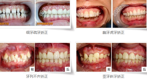 <!--<i data=20240705-sp></i>-->口腔龅牙牙不齐矫正效果图