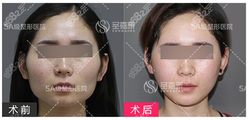 北京圣嘉新医疗美容颧骨颧弓下颌角轮廓手术对比照片